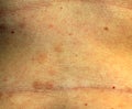 Red Flat Lichen planus. Red spots on the skin of the abdomen Royalty Free Stock Photo