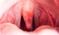 Red, inflamed and swollen uvula in the throat. Treatment of uvulitis due to bacteria and streptococcal viruses