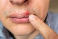 Red inflammation and herpes zoster virus on upper male lip Royalty Free Stock Photo
