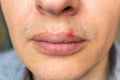 Red inflammation and herpes zoster virus on upper male lip