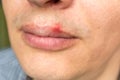 Red inflammation and herpes zoster virus on upper male lip