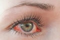 Red irritated human eye close up, allergy symptom Royalty Free Stock Photo