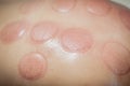 Red marks, cupping therapy, vacuum spots on woman back Royalty Free Stock Photo