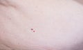 Red moles of nevi on the abdomen in humans, hemangioma