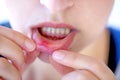 Red and painful canker sore Royalty Free Stock Photo