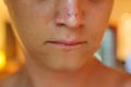 red painful skin, sunburn on the boy's face, sunburn protection need, lose-up face of a cute caucasian boy with a Royalty Free Stock Photo