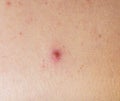 Red pimple on face macro, abscess and acne Royalty Free Stock Photo