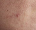 Red pimple on face macro, abscess and acne Royalty Free Stock Photo