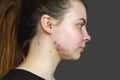 Red pimples on the skin of a young girl close-up. Acne on the face of a teenage girl.  Problems and treatment of acne in young peo Royalty Free Stock Photo