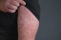 Red rash on forearm. Hand afflicted ÃÂ²ermatophytosis on skin. Erysipelas Royalty Free Stock Photo