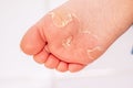 After the red rash and the strawberry tongue caused by scarlet fever the affected skin often peels - Here Skin of foot