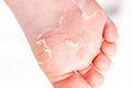 After the red rash and the strawberry tongue caused by scarlet fever the affected skin often peels - Here Skin of foot