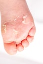 After the red rash and the strawberry tongue caused by scarlet fever the affected skin often peels - Here Skin of foot