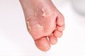 After the red rash and the strawberry tongue caused by scarlet fever the affected skin often peels - Here Skin of foot