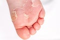 After the red rash and the strawberry tongue caused by scarlet fever the affected skin often peels - Here Skin of foot