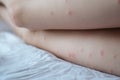 Red rash on the white skin of female legs, pimples