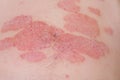 Red redness, spots on the skin.Large red inflamed scaly rash on the stomach. Acute psoriasis on the stomach in a man