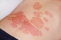 Acute psoriasis on the stomach in a man, severe redness on the skin, an autoimmune incurable dermatological skin disease