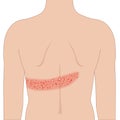Red shingles rash allergy on the back skin body, illustration on white background Royalty Free Stock Photo