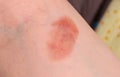 Red spot on the skin, skin damage from a burn on the arm. Close-up Royalty Free Stock Photo