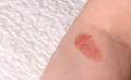 Red spot on the skin, skin damage from a burn on the arm. Copy space for text Royalty Free Stock Photo