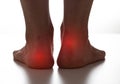 Red spots on dark female legs. Concept of pain and inflammation from calluses and warts on the feet. Close-up