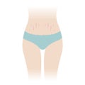 Red stretch marks on tummy vector illustration isolated on white background.