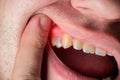 Red and swollen gums in a man. Gum disease gingivitis, flux and inflammation. Macro