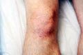 Reddened skin on the knee after carbon dioxide therapy carboxytherapy