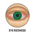 Redness of the eyes. Symptom of conjunctivitis, allergies, inflammation of the eyes. Eye redness icon. Infographics