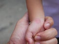 Redness, itching, and swelling after a mosquito bite on a little baby`s wrist - allergy to mosquito saliva in babies