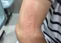 Redness, from scar treatment laser, on an arm