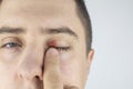 A man stands in front of a mirror and sees inflammation of the upper eyelid. Redness of the skin around the eyes and blepharitis