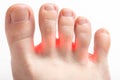 Redness between the toes, onychomycosis, macro. Foot fungus disease treatment concept, dermatitis