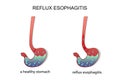 Reflux esophagitis stomach. Royalty Free Stock Photo