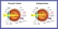 Refractive errors eyeball. Astigmatism. Medicine.