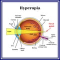 Refractive errors eyeball. Hyperopia. Medicine Royalty Free Stock Photo