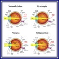 Refractive errors eyeball: hyperopia, myopia, astigmatism. Royalty Free Stock Photo