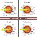 Refractive errors eyeball: hyperopia, myopia, astigmatism. Royalty Free Stock Photo