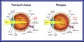 Refractive errors eyeball. Myopia. Medicine.