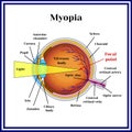 Refractive errors eyeball. Myopia. Medicine Royalty Free Stock Photo