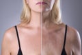 Rejuvenation woman`s skin, before after anti aging concept, wrinkle treatment, facelift and plastic surgery