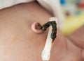 The remains of the umbilical cord in a baby after birth. Healing of the umbilical wound and umbilical ring, close-up