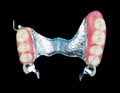Removable dental prosthesis Royalty Free Stock Photo