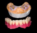Removable denture