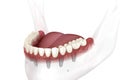 Removable mandibular prosthesis all on 6 system supported by implants. Medically accurate 3D illustration of human teeth and