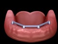 Removable Mandibular prosthesis with gum All on 4 system supported by implants. Medically accurate 3D illustration of human teeth