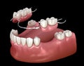 Removable partial denture, mandibular prosthesis. Medically accurate 3D illustration of prosthodontics concept Royalty Free Stock Photo