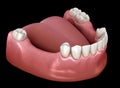 Removable partial denture, mandibular prosthesis. Medically accurate 3D illustration of prosthodontics concept Royalty Free Stock Photo