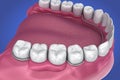 Removable partial denture. Medically accurate Royalty Free Stock Photo